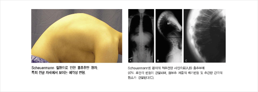 척추 뼈