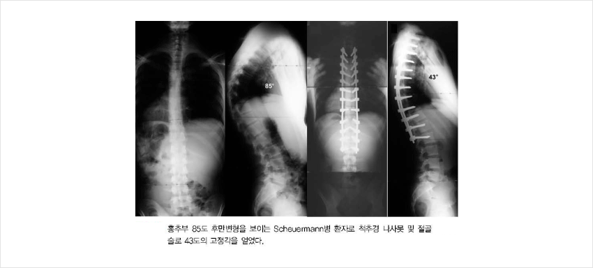 척추 뼈