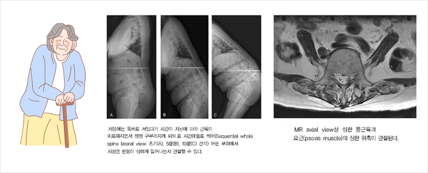 척추 뼈